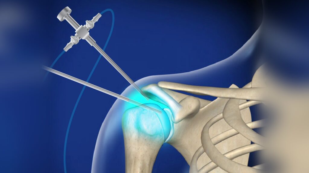 عمل جراحی آرتروسکوپی: گامی نوین در دنیای درمان 1 diagnosticarthroshoulder 1280 1